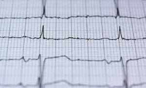 Researchers Create Open-source Solution to Monitor Cardiac Arrhythmias
