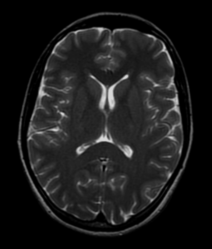 Brain-T2-axial