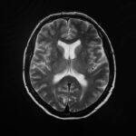 AI Toolkit Aims to Speed Neurodegenerative Research